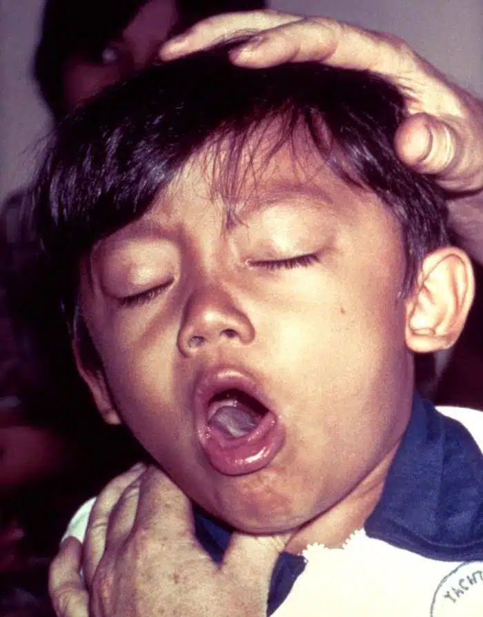 bacterial infection