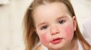 The Pediatrician's Guide to Managing Allergies in Children 2 allergies