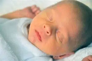 Hydrocephalus: Understanding the "Water on the Brain" Condition in Children 2 Hydrocephalus