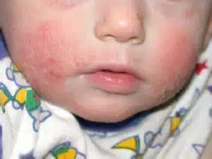 Red Skin in Newborns: Causes, Soothing Tips & When to Worry 1 newborn-baby-is-red